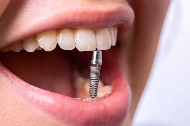 Протезирование зубов. Нейлоновые зубные протезы