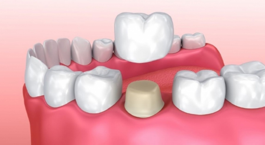 Насколько эффективным является протезирование зубов коронками?