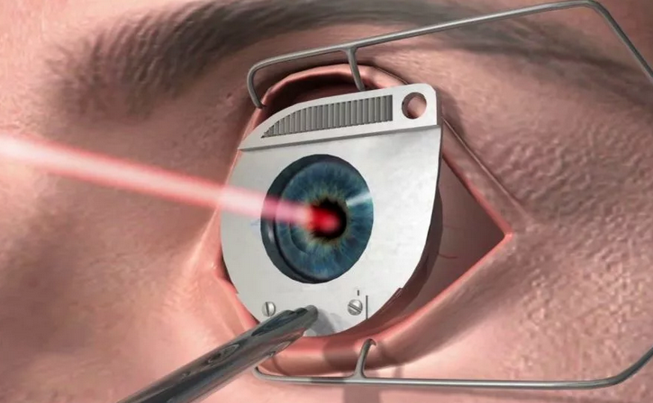 Диагностика и операция - лазерная коррекция зрения в Москве